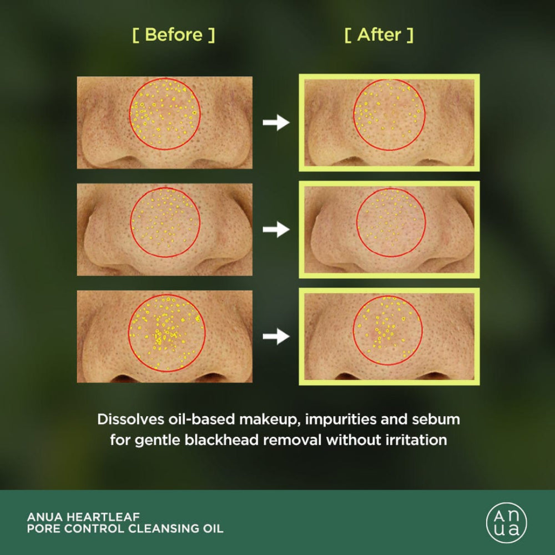 Before and after comparison of skin with blackheads using Anua Heartleaf Pore Control Cleansing Oil