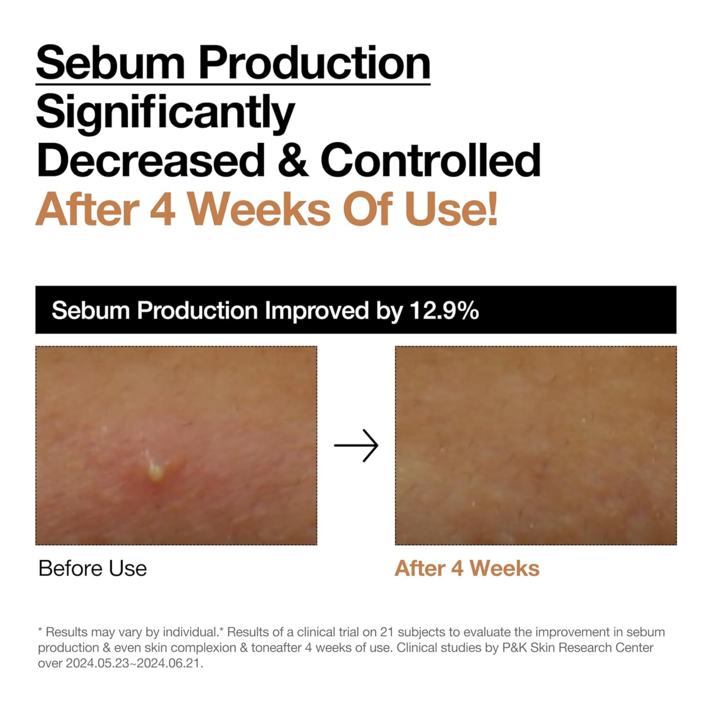 Before and after comparison of sebum production improvement with text indicating decreased and controlled sebum production after 4 weeks of use of the Anua Rice 70 Glow Milky Toner