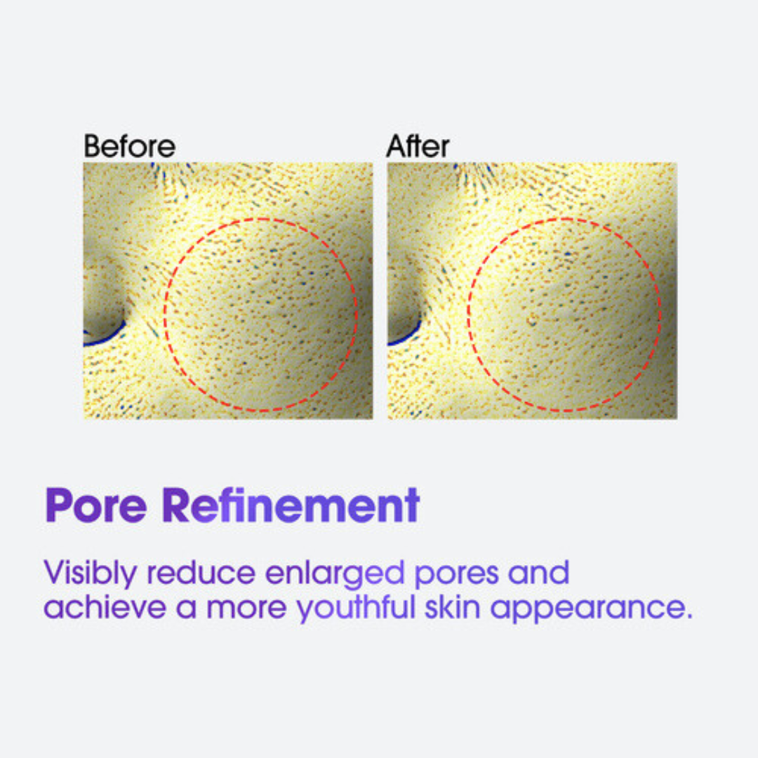 Before and after comparison of pore refinement with a red circle highlighting pores. SOME BY MI Retinol Intense Advanced Triple Action Eye Cream