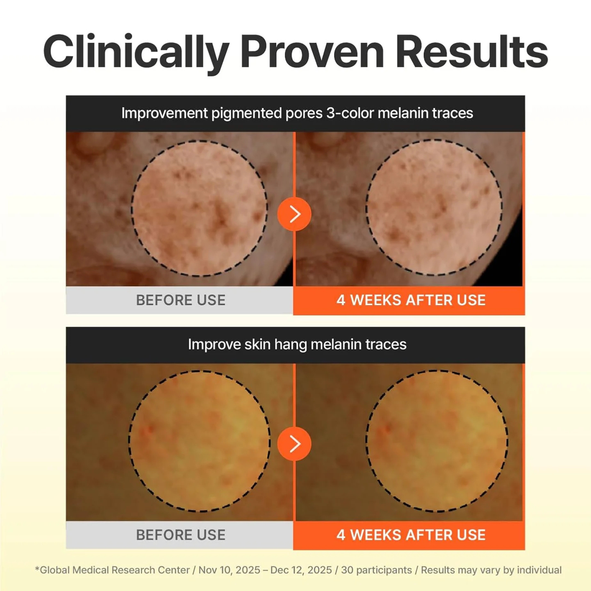 Before and after skin improvement results or pigmented pores and melanin traces with clinical proven claims. Results are after 4 weeks of use of the Centellian24 Madeca Vitamin 15+ Glowing Serum.
