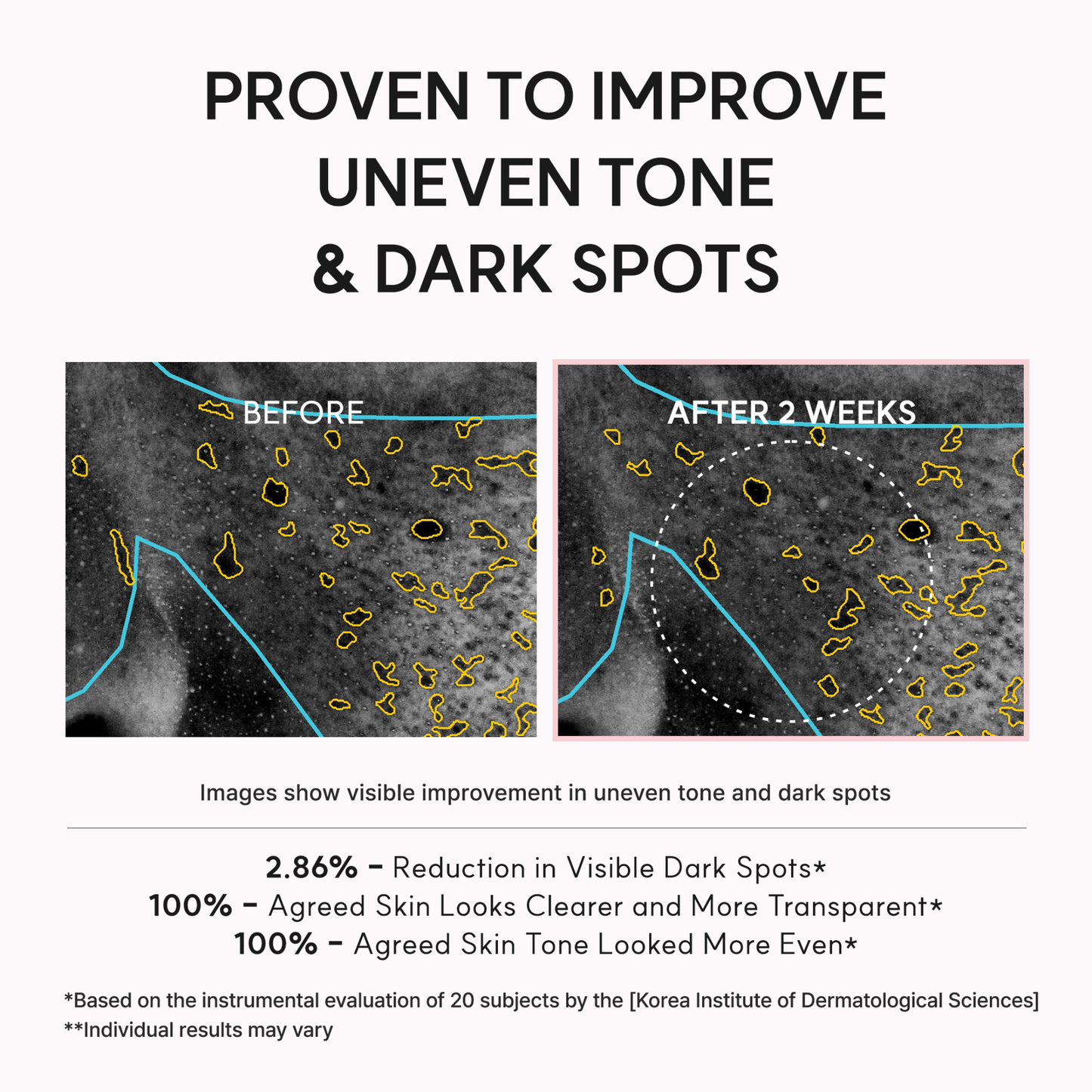 Before and after comparison of skin with dark spots, showing improvement over 2 weeks of use of the ARENCIA TXA Booster Shot.