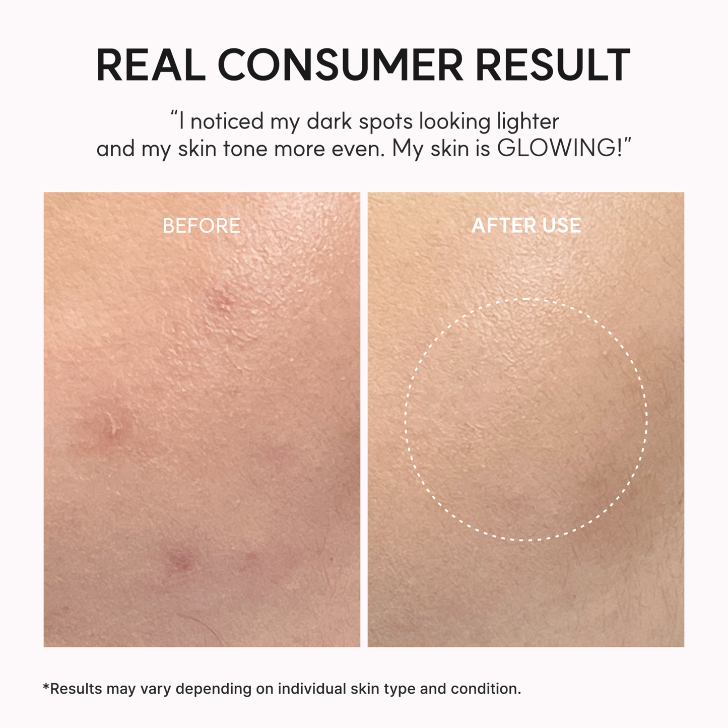A before-and-after skin comparison graphic with the headline 'REAL CONSUMER RESULT.' The top text includes a customer quote about dark spots fading and even skin tone. Results are obtained after the use of the ARENCIA TXA Booster Shot.