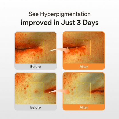 Before and after comparison of hyperpigmentation improvement on skin with text 'See Hyperpigmentation improved in Just 3 Days'. Abib Glutathiosome Dark Spot Serum Vita Drop