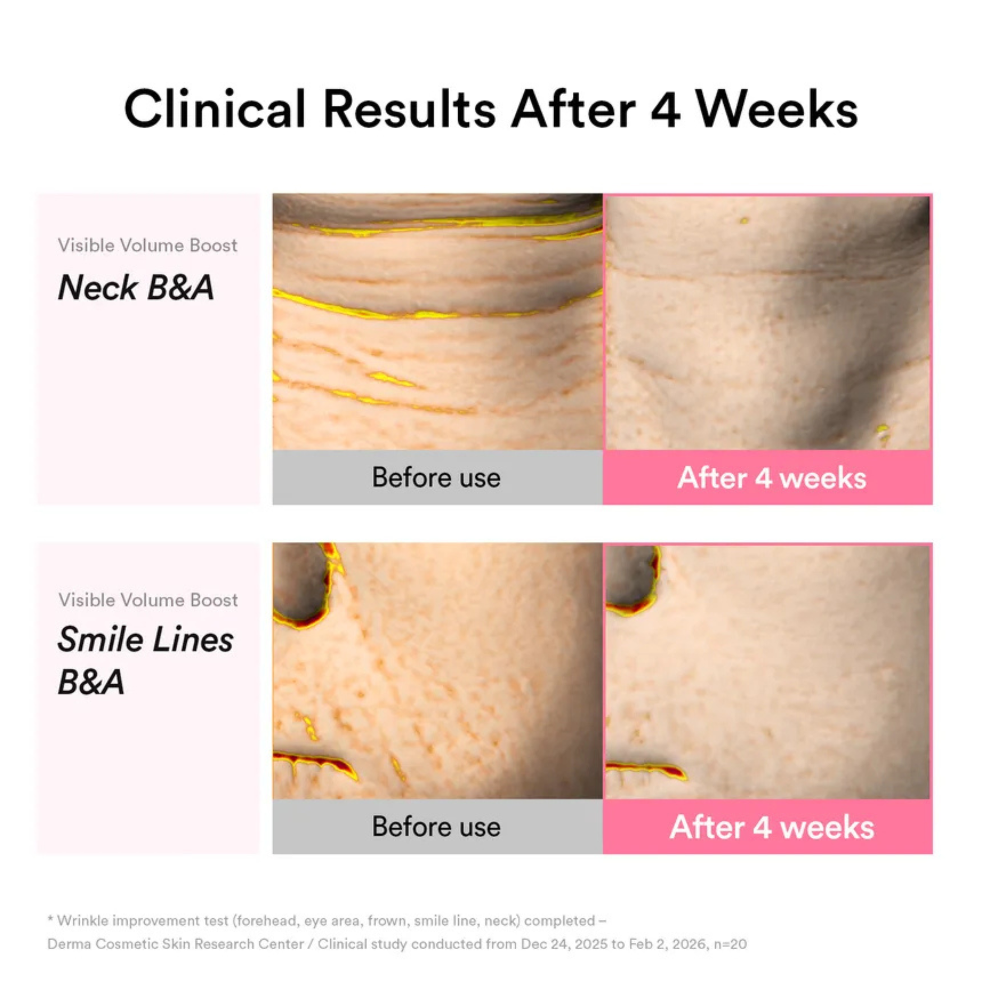 Before and after clinical results of Abib PDRN Volume Fill-It Booster Cream 2.5 Tube on neck and smile lines after 4 weeks.
