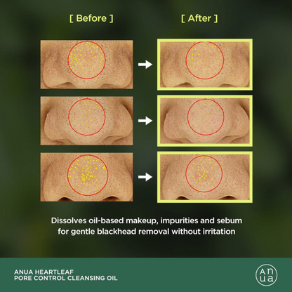 Before and after comparison of skin with blackheads using Anua Heartleaf Pore Control Cleansing Oil