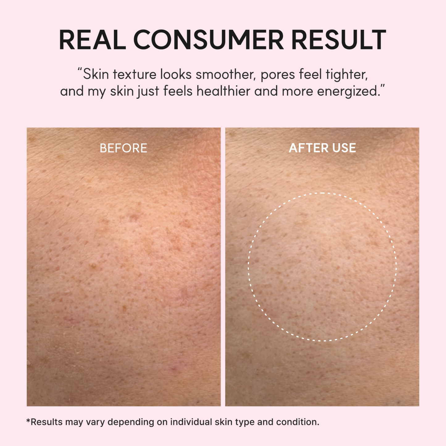 A before-and-after skin texture comparison on a light pink background. The top text reads 'REAL CONSUMER RESULT' with a quote about smoother skin and healthier skin texture. The results were obtained after the use of the ARENCIA PDRN Booster Shot