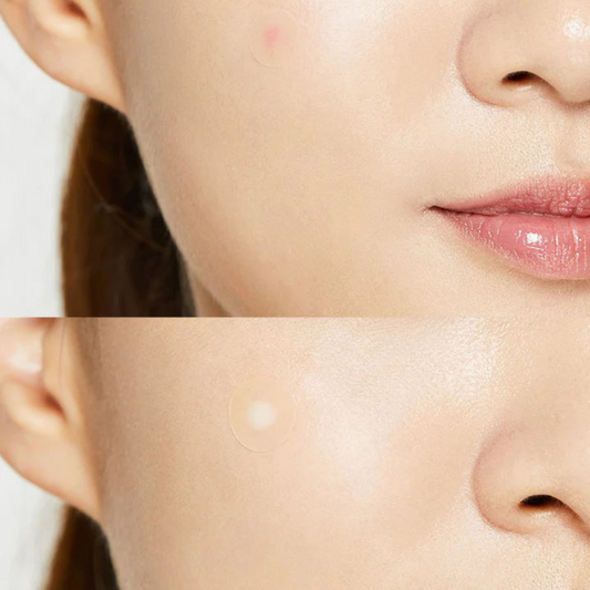 COSRX Acne Pimple Master Patch on a woman's face to show absorption 