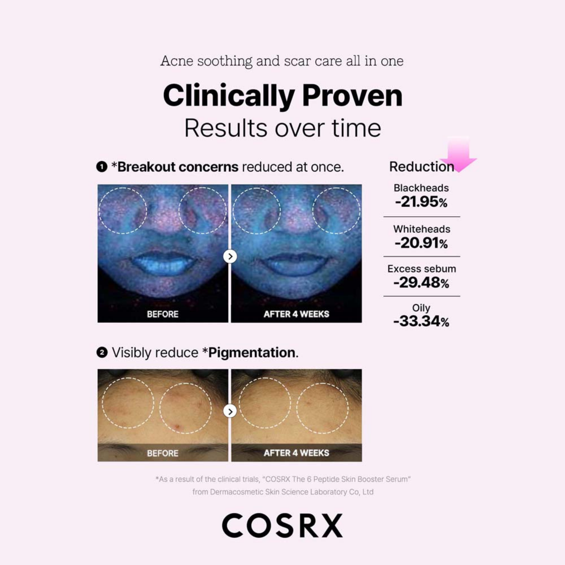 Before and after effects on skin with clinical results of breakouts and pigmentation after the use of COSRX The 6 Peptide Skin Booster for a 4 week period.