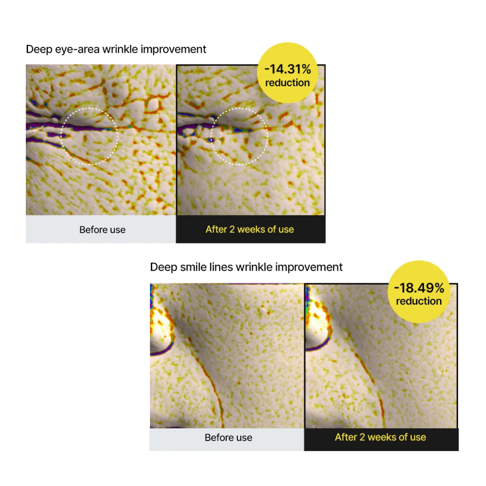 Before and after images of deep eye-area and smile lines wrinkle improvement with numerical reductions.