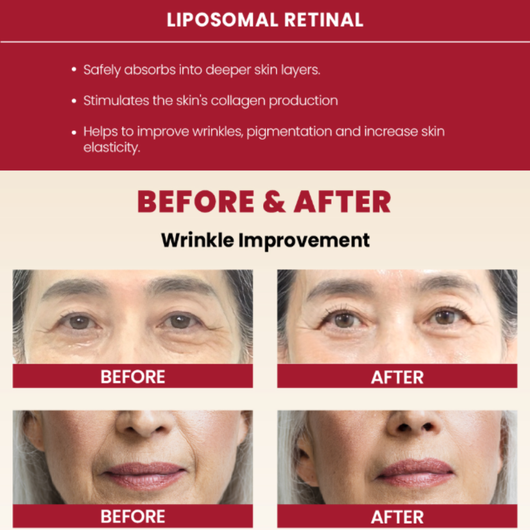 Before and after effects of liposomal retinal on skin with wrinkle improvement. K-SECRET Seoul 1988 Cream: Retinal Liposome 1% + Fermented Rice