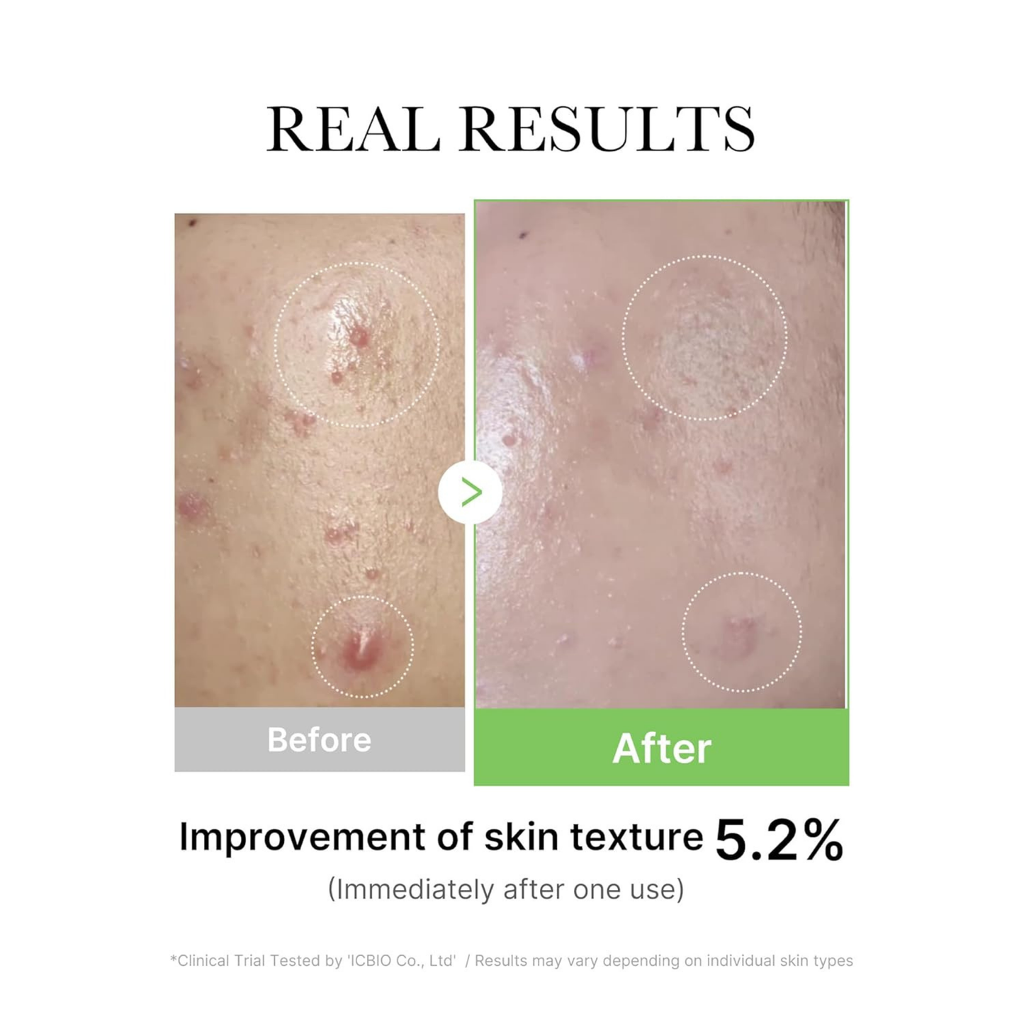 Before and after comparison of skin texture improvement with a 5.2% improvement immediately after one use, shown on a white background.