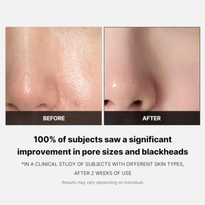 Before and after comparison of skin  of the nose with pore sizes and blackheads, showing a clinical study result of using Medicube Zero Pore Pads