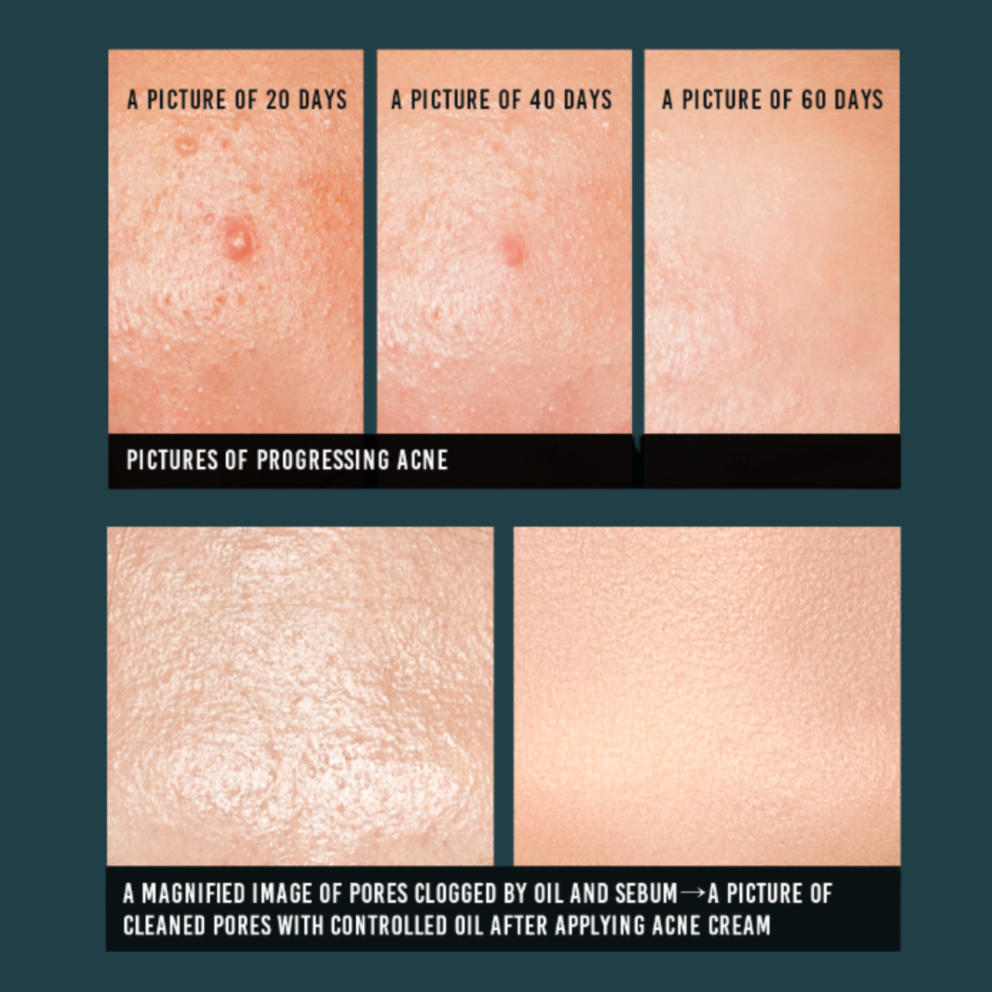 Before and after comparison of acne-prone skin over 60 days of using the Pyunkang Yul Acne Cream with text indicating progress.