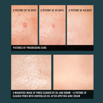 Before and after comparison of acne-prone skin over 60 days of using the Pyunkang Yul Acne Cream with text indicating progress.