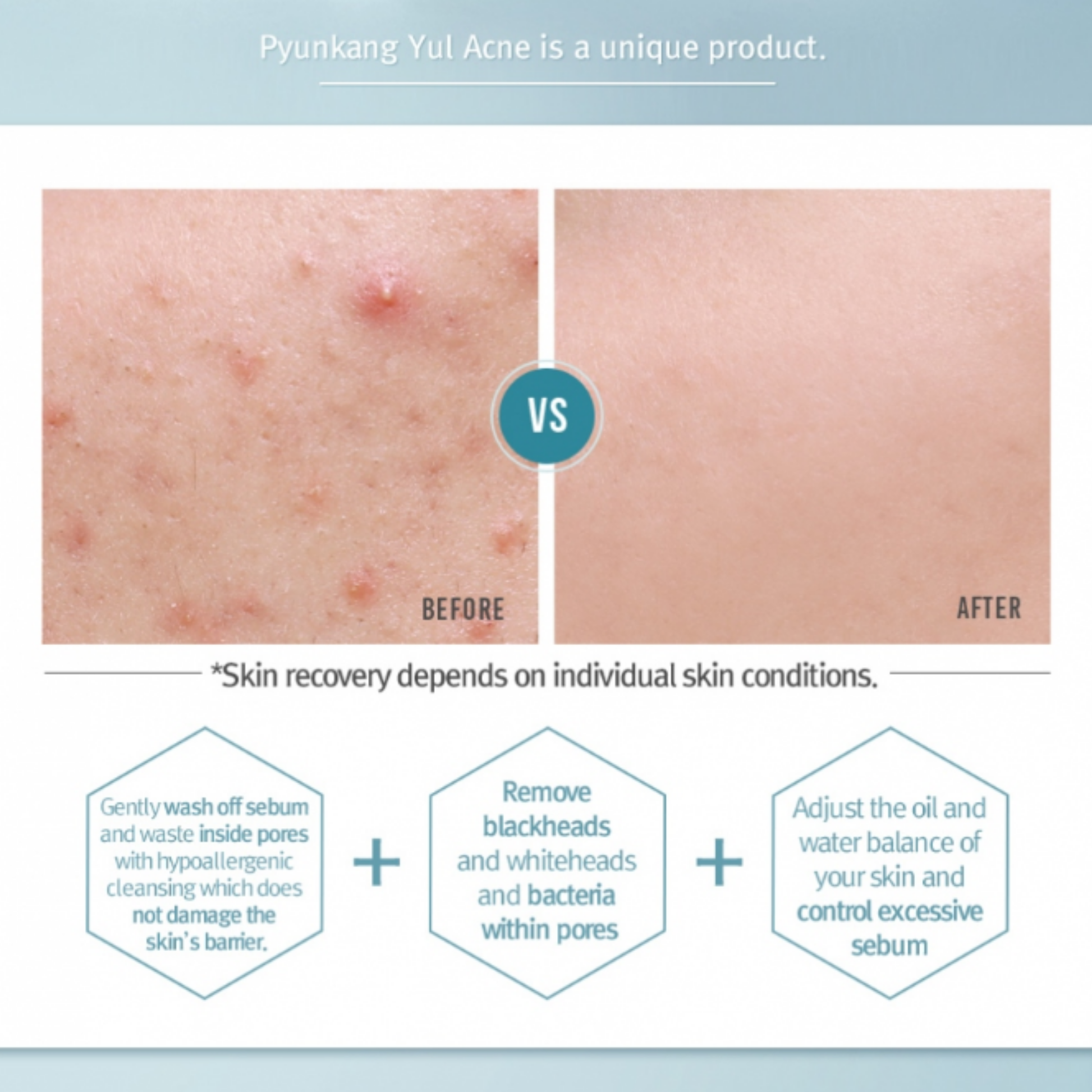 Before and after comparison of skin with acne after using Pyunkang Yul Acne Facial Cleanser
