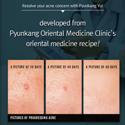 Pyunkang Yul advertisement showing progress of acne treatment over 20, 40, and 60 days.