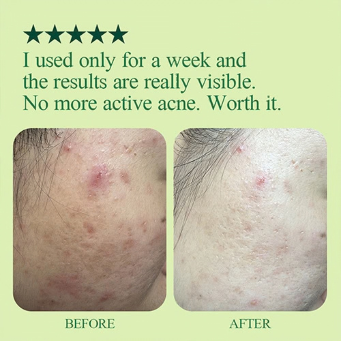 Before and after comparison of skin with the use of Pyunkang Yul Ultimate Calming Solution Ampoule on a green background