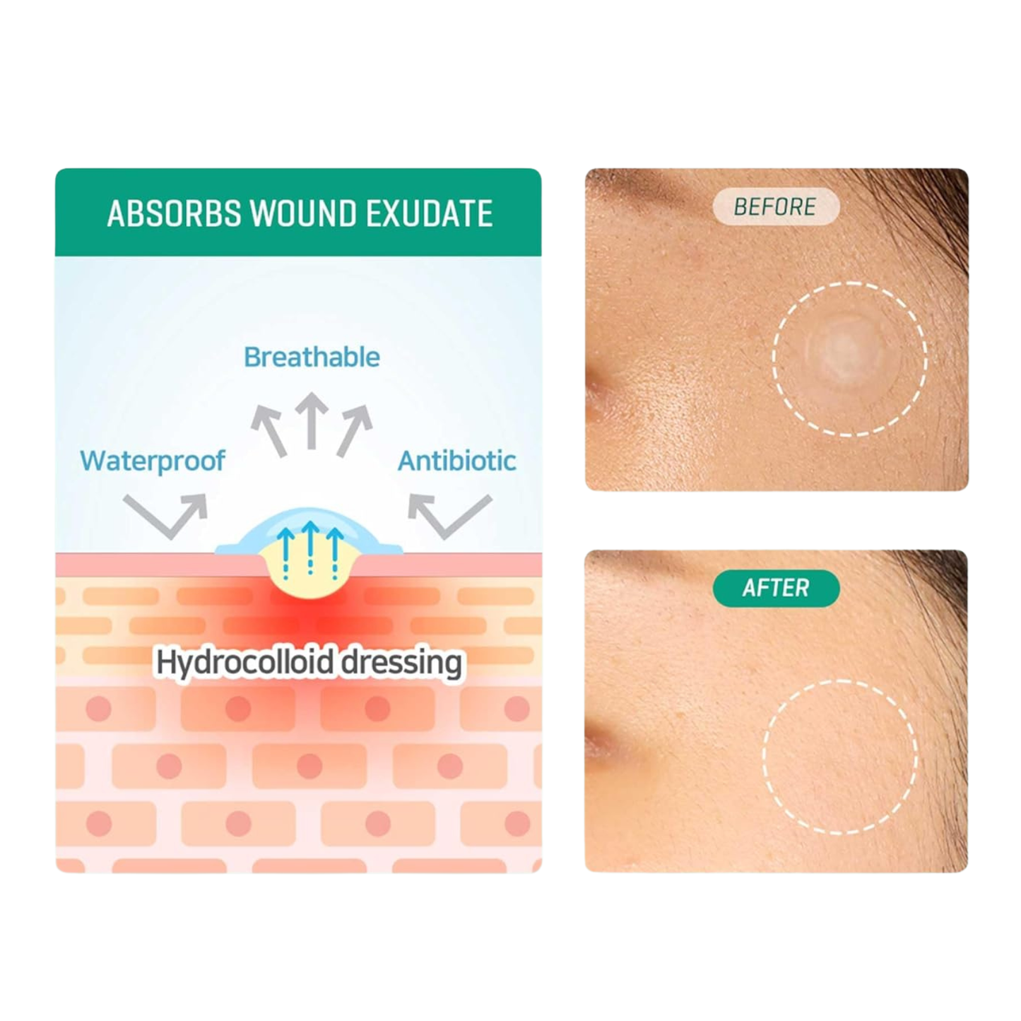 Hydrocolloid dressing illustration with 'Before' and 'After' skin images on a white background.  SOME BY MI 30 Day Miracle Clear Spot Patch